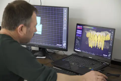 Exocad ile implant üstü restorasyon tasarımı — çift ekranlı CAD iş istasyonu